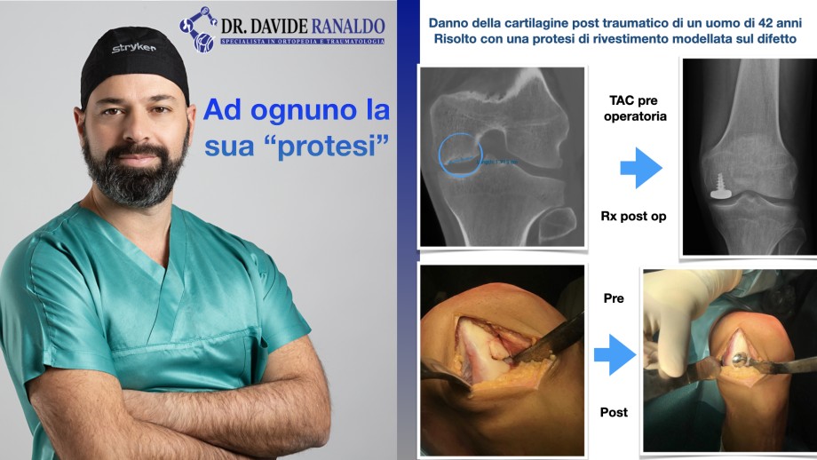 Ostecondrite del ginocchio