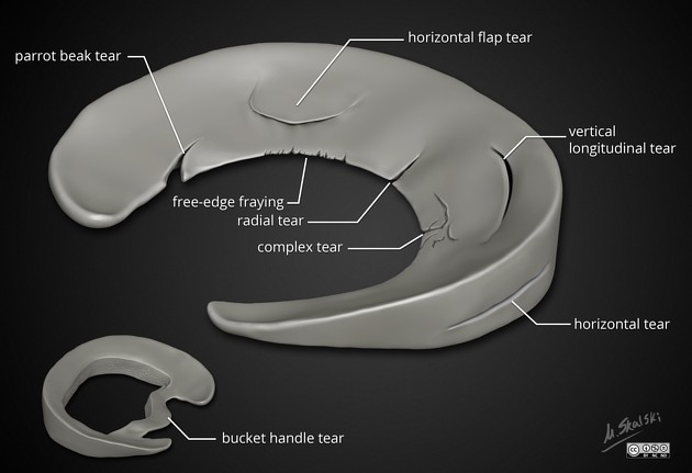 Lesioni del menisco